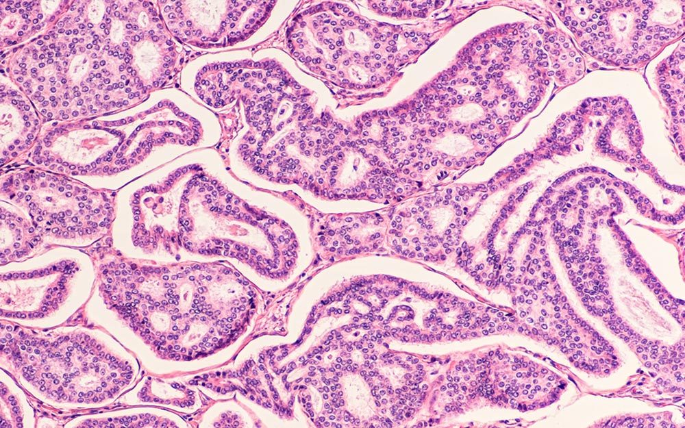 Breast-cancer