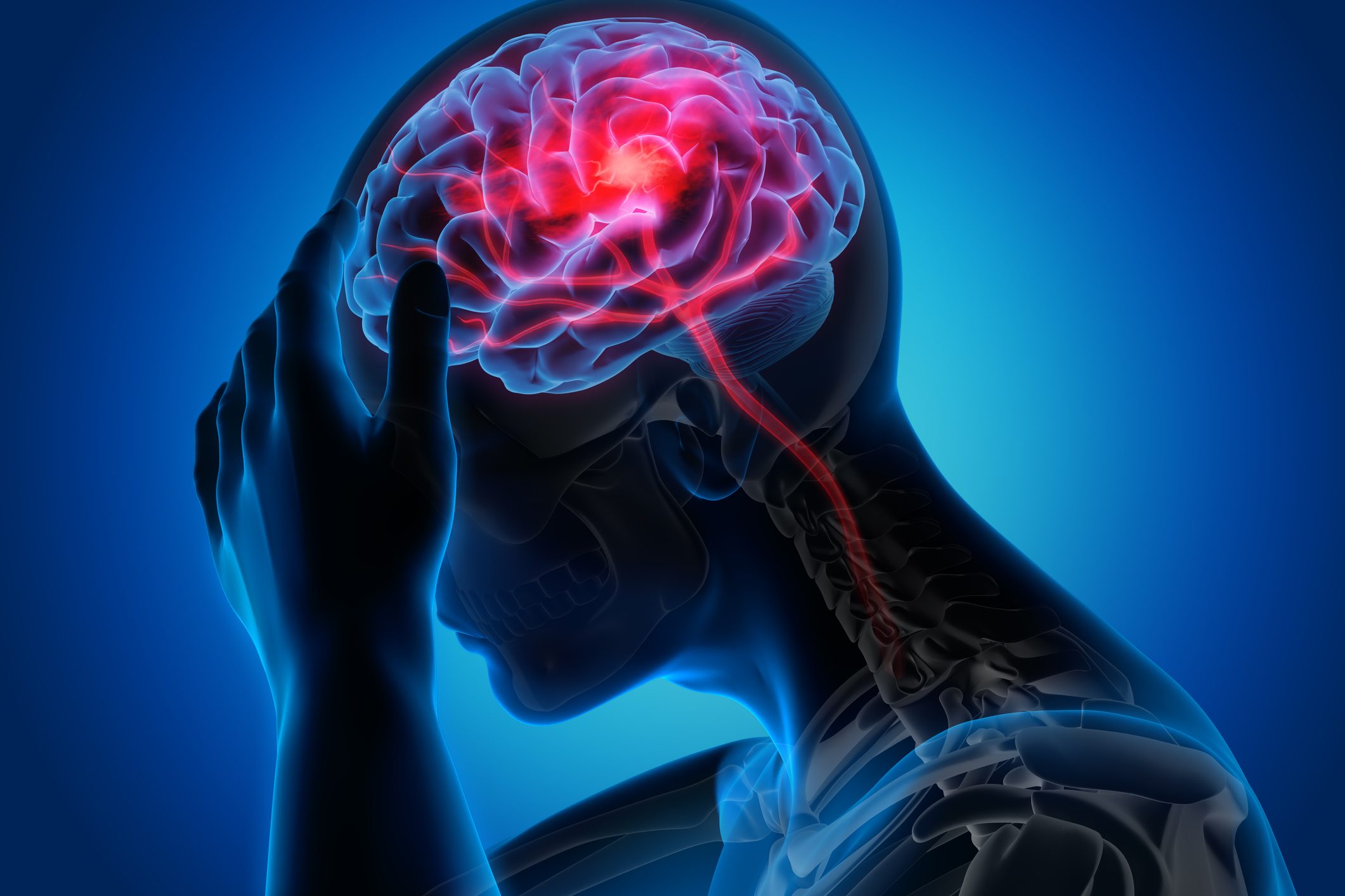 medical stroke diagram