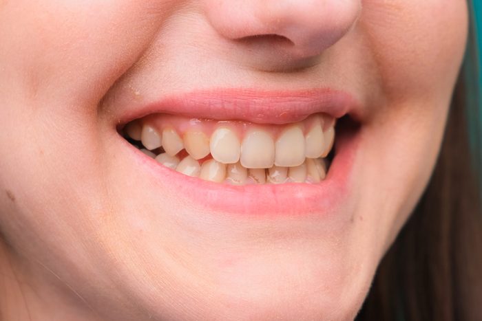 female with yellow teeth due to fluorosis
